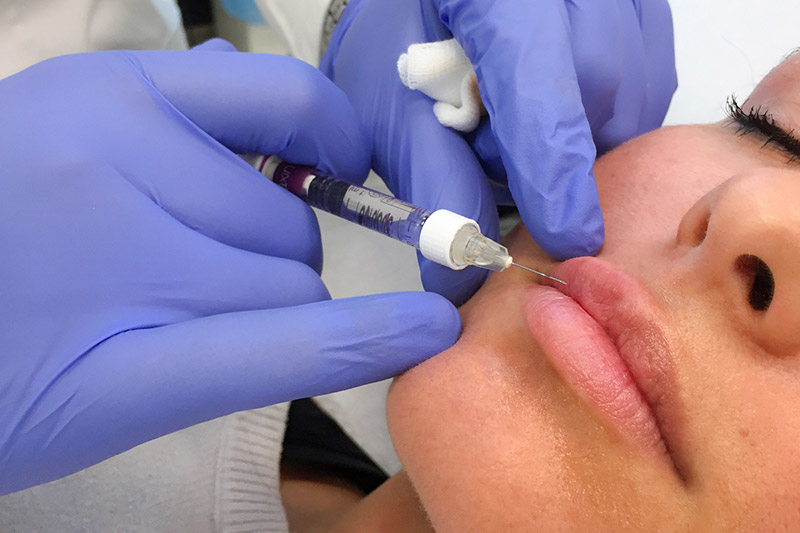 Filler labbra