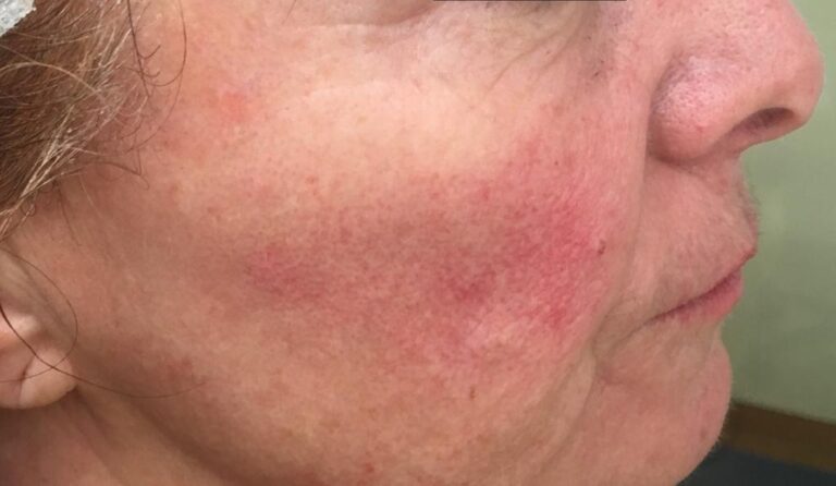 Patologia Rosacea
