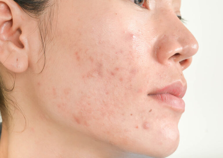 cos'è l'acne