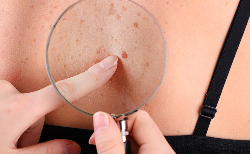 Aprile: mese della prevenzione dermatologica e mappatura dei nei