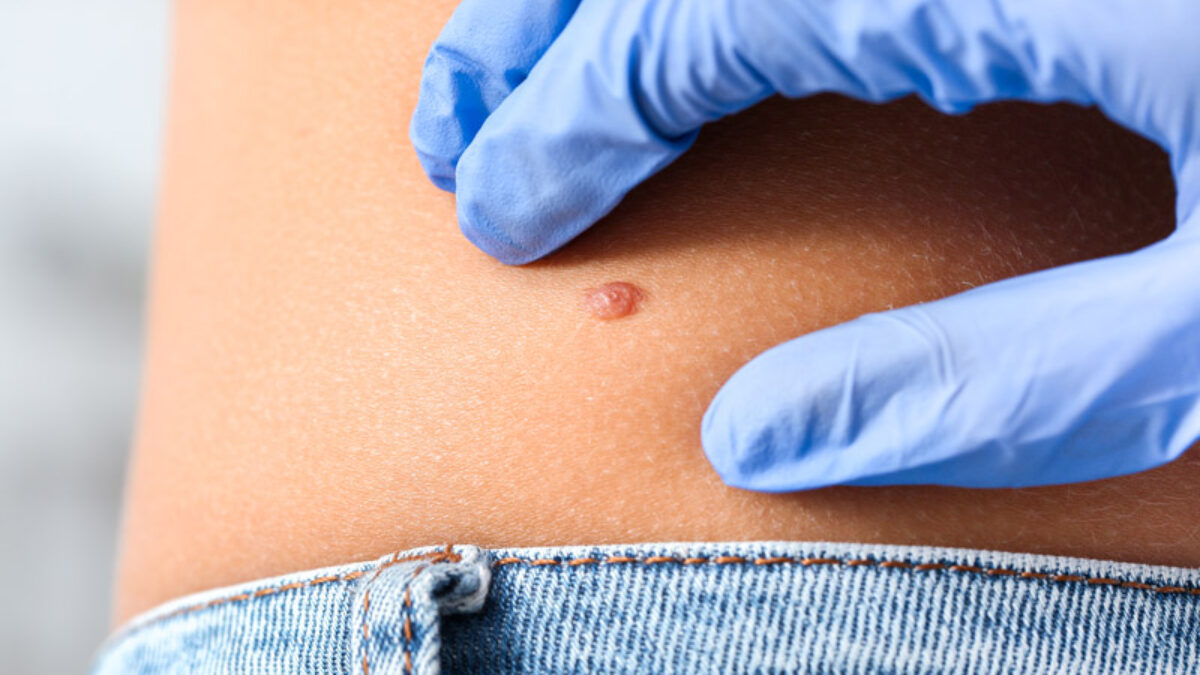 In 20 anni il melanoma è raddoppiato in Italia: crema solare non basta