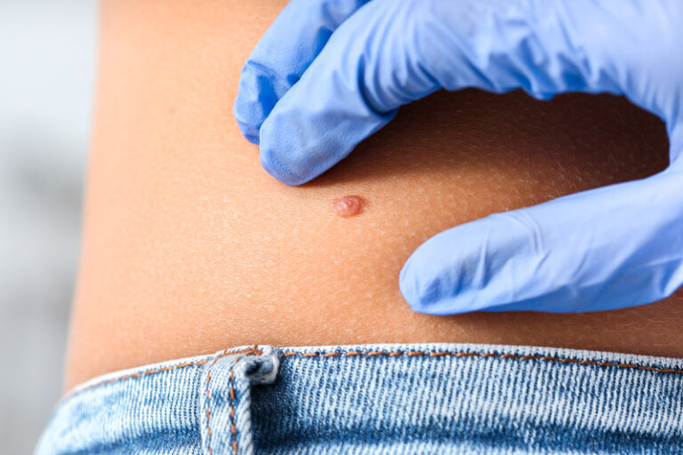 Melanoma della pelle
