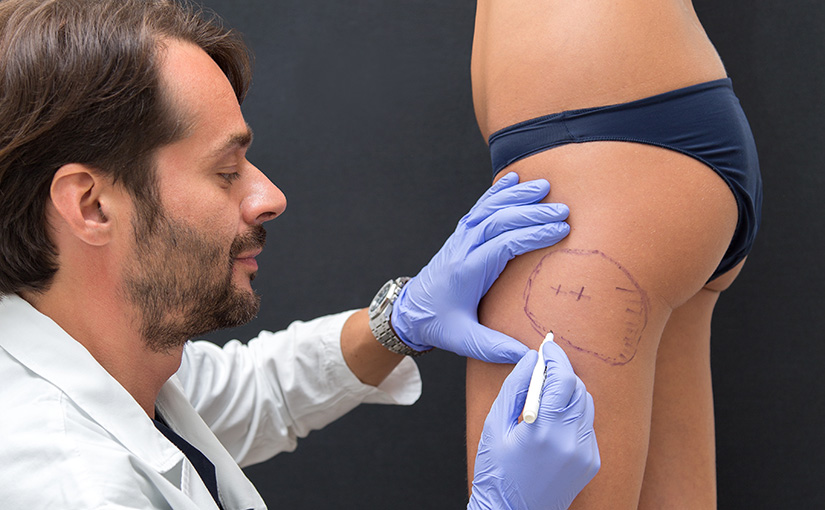 Cura della cellulite: protocollo su misura