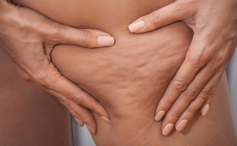 Subcision cellulite