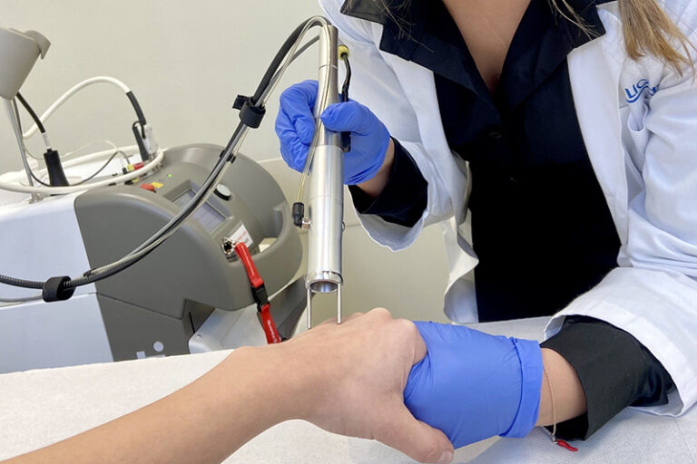 epilazione laser peli superflui