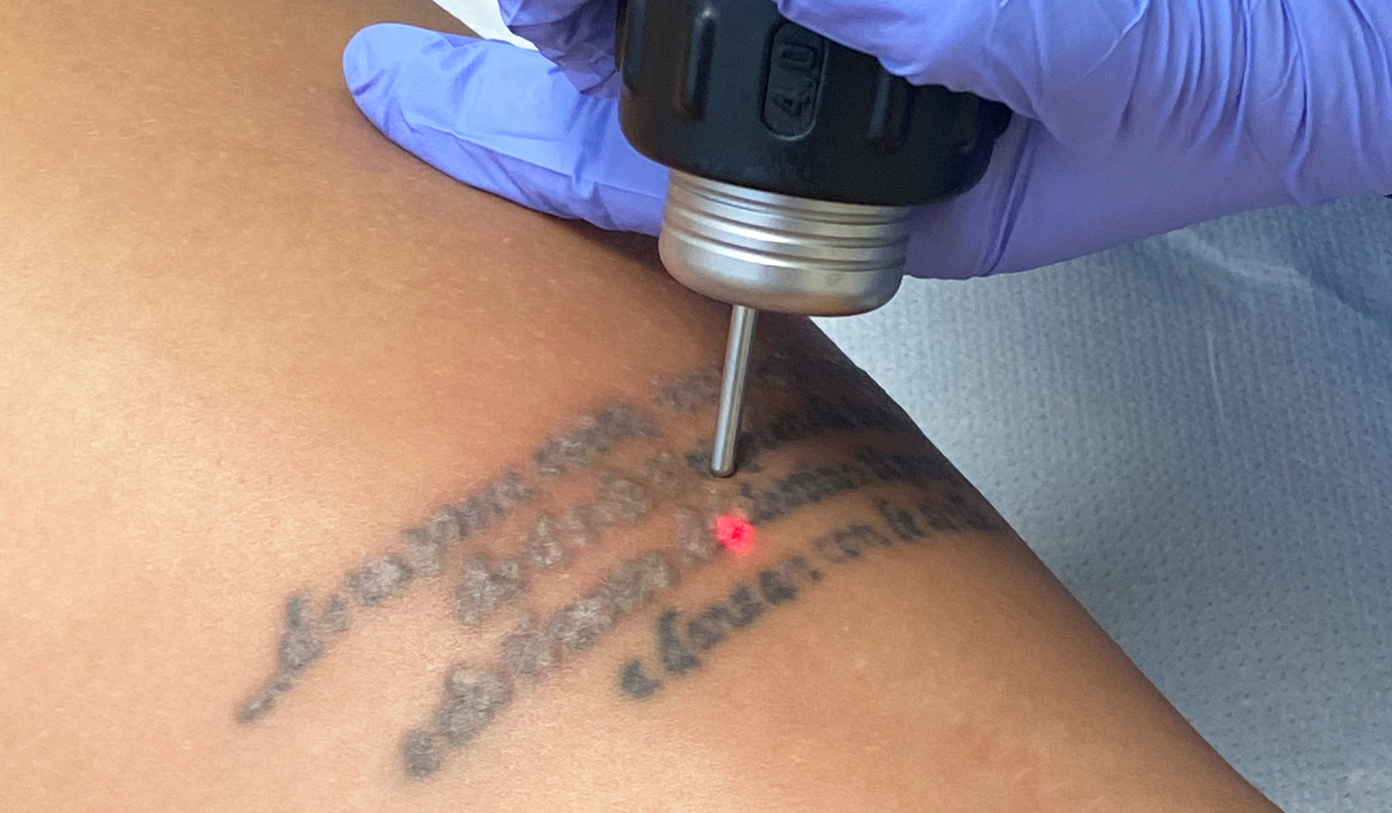 rimozione tatuaggi: domande e risposte