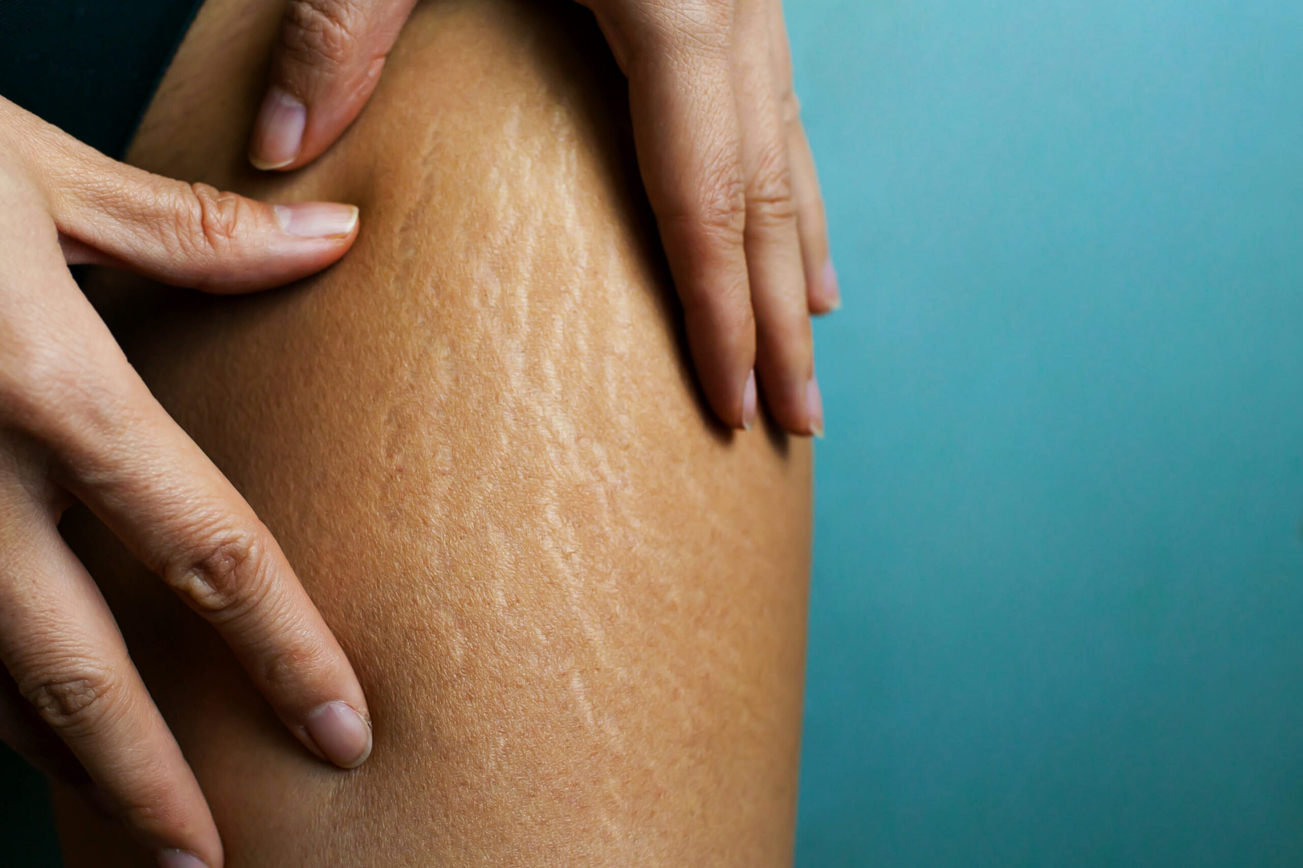 Stretch Marks On Woman's Legs. Female Hand Holds Fat Cellulite A