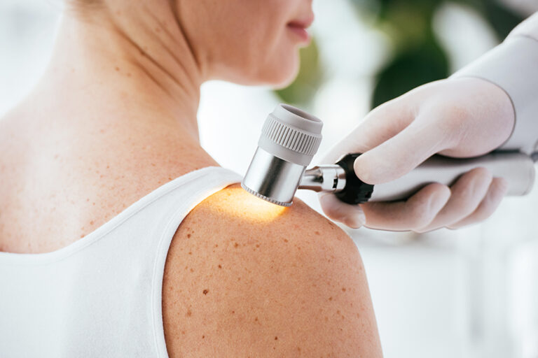 Melanoma: cos’è, come prevenirlo e come curarlo