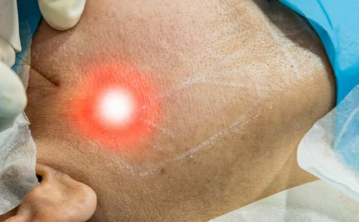Endolift trattamento lifting estetico viso con fibre ottiche
